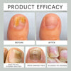 NailDrops 1+1 GRATIS: Flüssige Nagelpilz-Reparatur-Heiltropfen