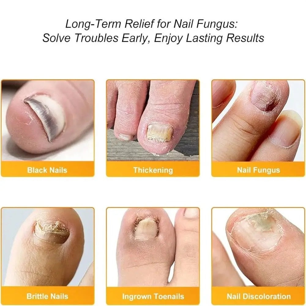 FungalPatch - Antibakteriell Pilzbefall Flicken Und Nagelpflege Packung